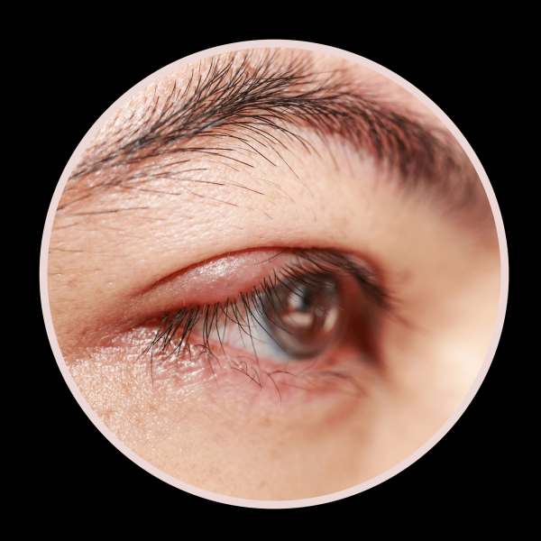6 Types of Eyelid Bumps and How to Treat Them According to Dermatologists